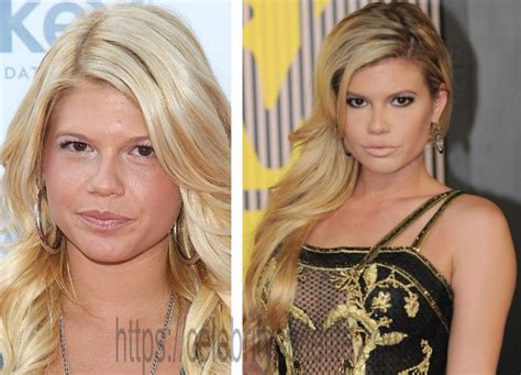 chanel west coast before surgery|chanel west coast implants.